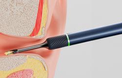 Bebird Chytrá vizuální tyč na čištění uší Note 5 (bílá)