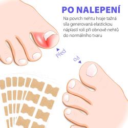 Wellife Náplasti proti zarůstání nehtů 100 ks