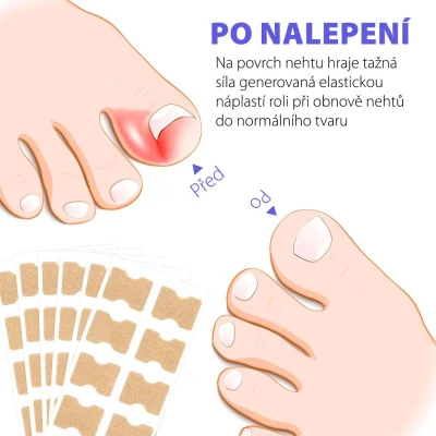 Wellife Náplasti proti zarůstání nehtů 100 ks