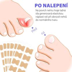 Wellife Náplasti proti zarůstání nehtů 100 ks (VÝPRODEJ)