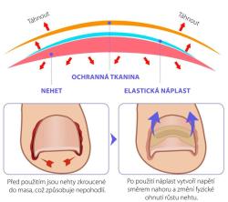 Wellife Náplasti proti zarůstání nehtů 100 ks (VÝPRODEJ)